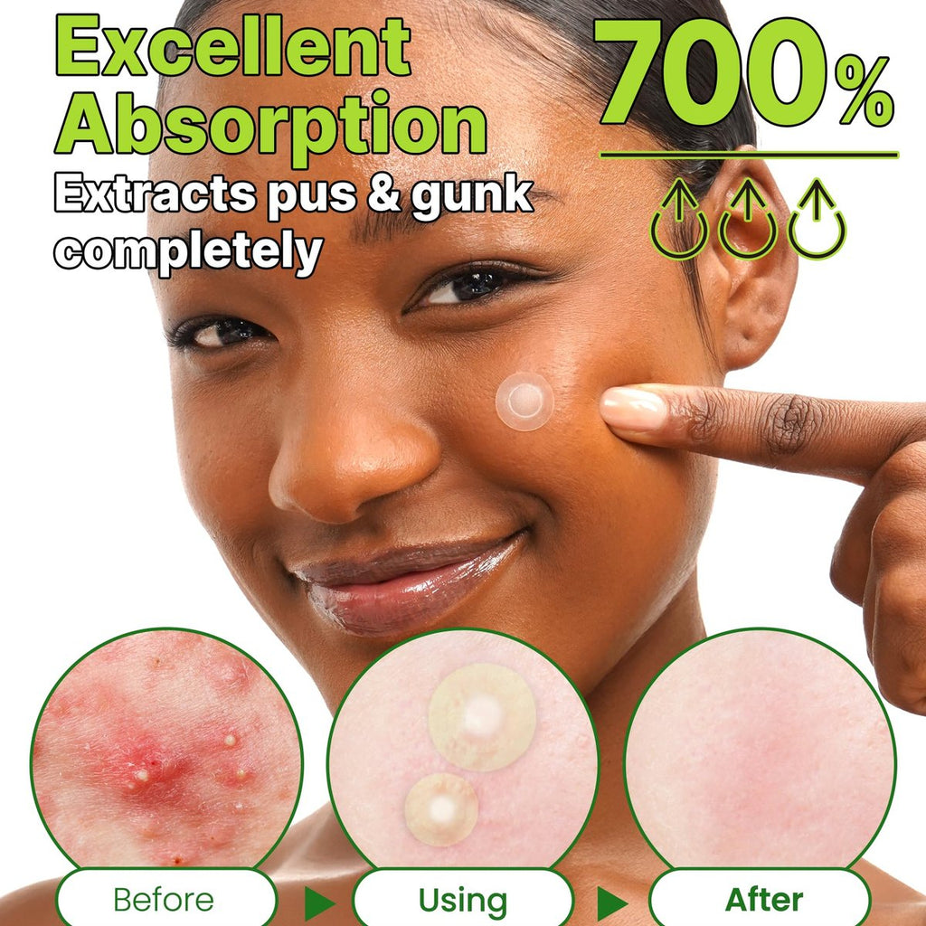 Parches Invisibles Anti-Acné con Árbol de Té 98% The Red Correct Invisible Spot Patch TROUBLESS - 96 Parches